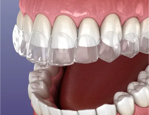Clear Aligners