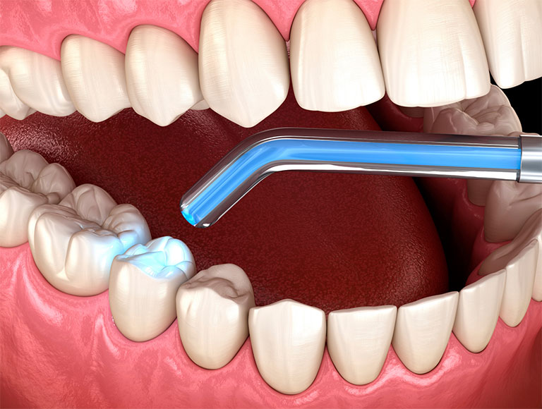 Is a Dental Filling the Right Choice for You?