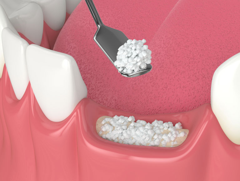 Bone Grafting Services