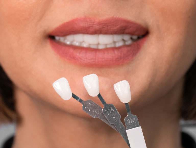Are Dental Veneers The Right Fit For You?