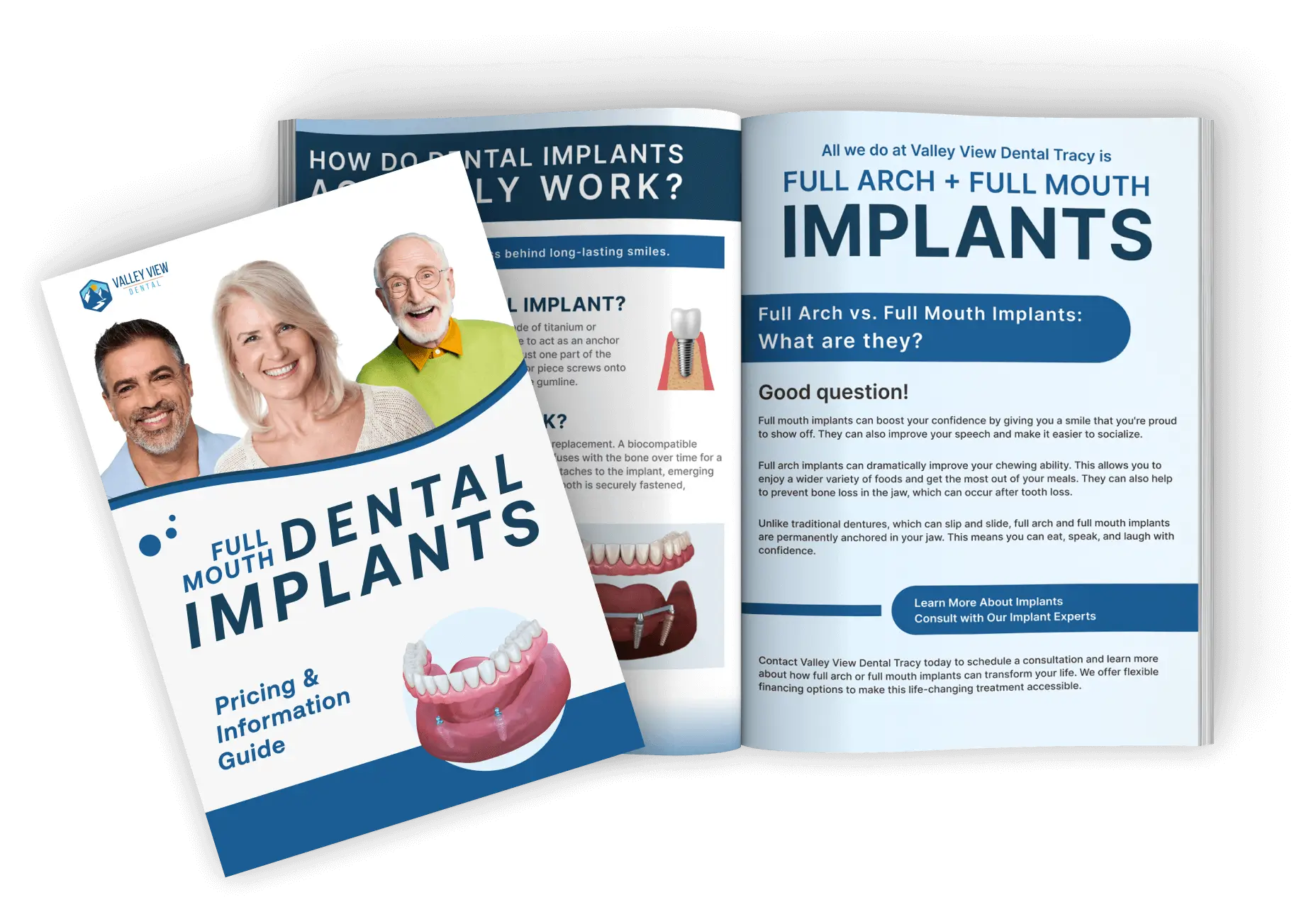 Dental Implant Guide