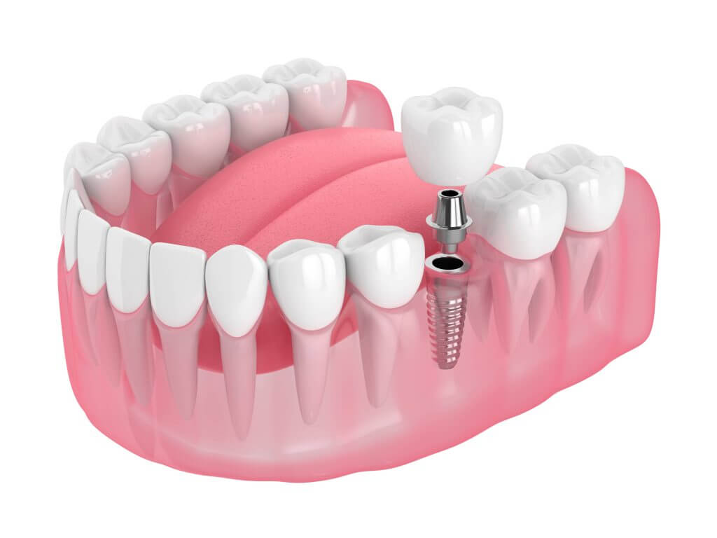 Single Missing Tooth