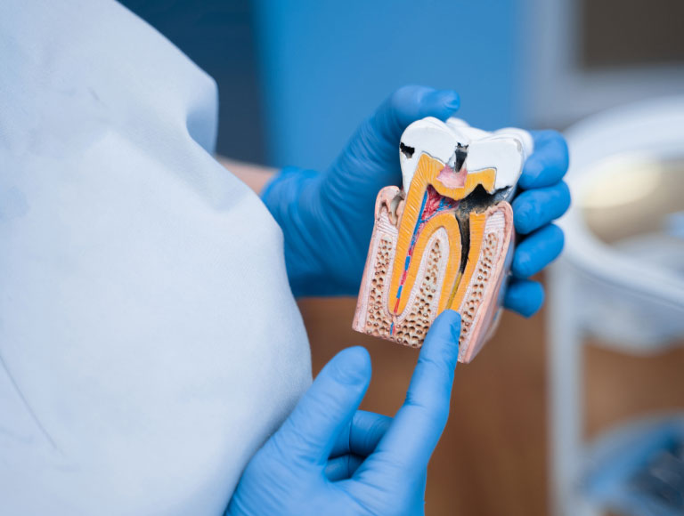 Signs You May Need a Root Canal