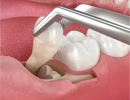 Wisdom Teeth extraction